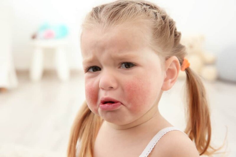 Uşaqlarda dərman allergiyası